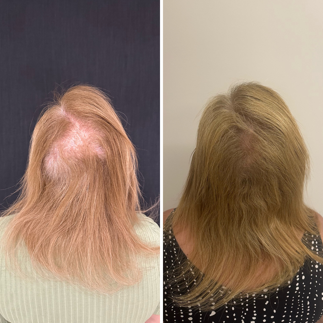 Resultado de tratamento capilar 7 — antes e depois